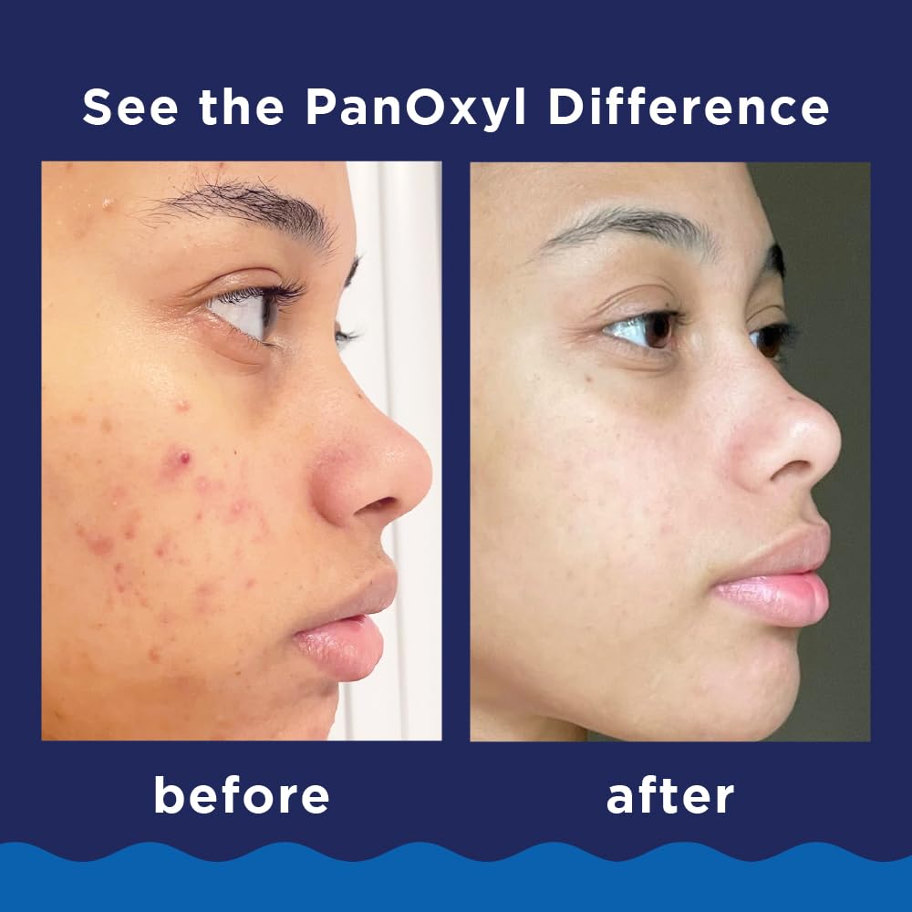 Acne Foaming Wash Benzoyl Peroxide 10% Maximum Strength Antimicrobial, 5.5 Oz (Pack of 2)