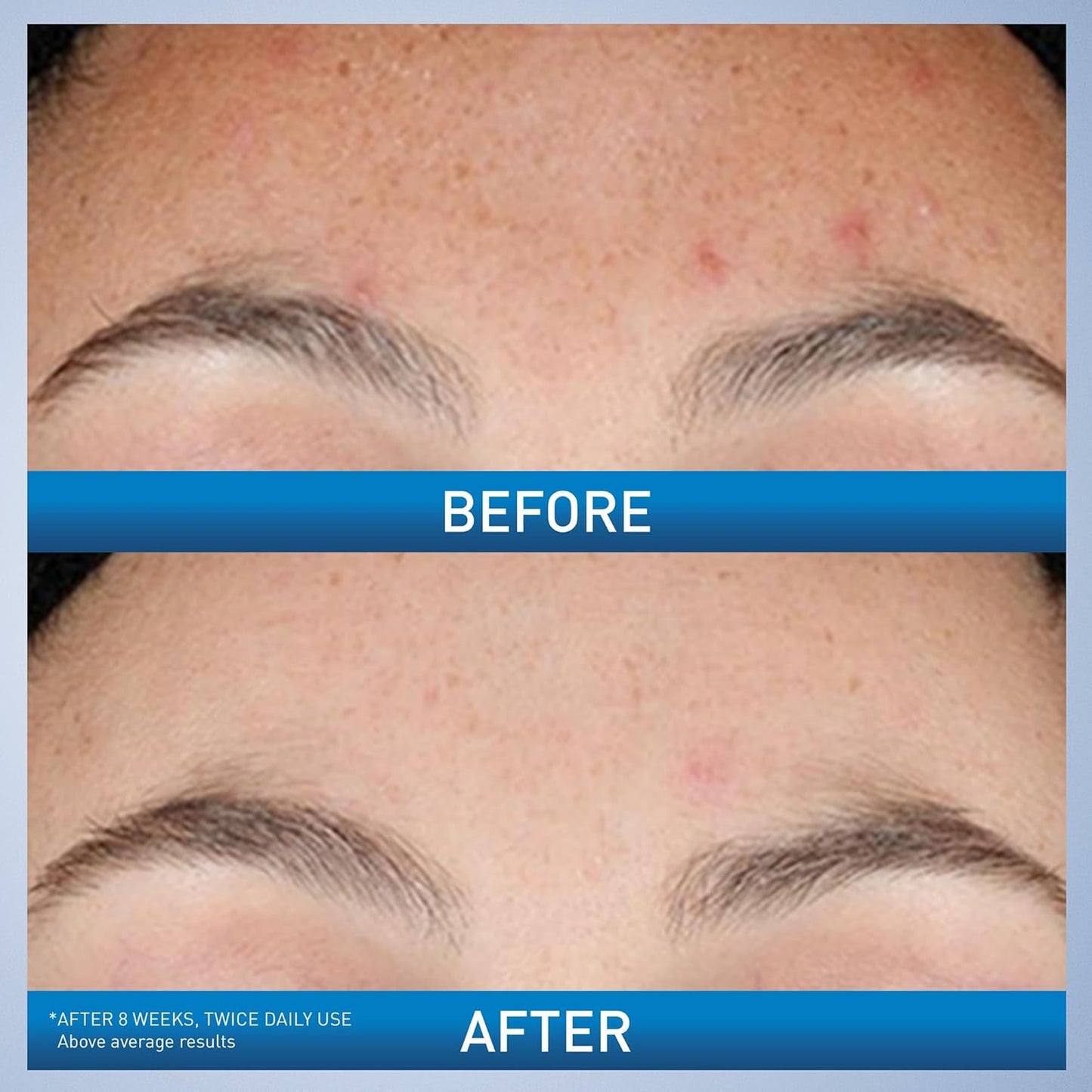 Resurfacing Retinol Serum for Post Acne Marks
