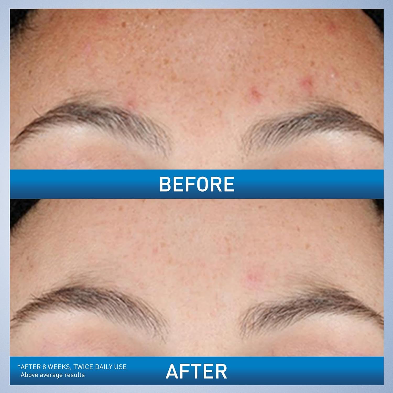 Resurfacing Retinol Serum for Post Acne Marks